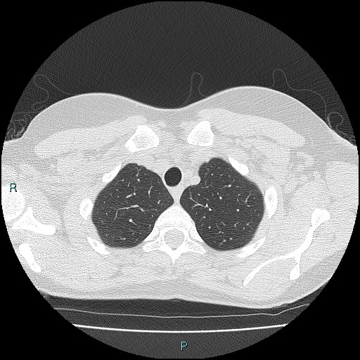 Accidental foreign body aspiration (seamstress needle) (Radiopaedia 77740-89983 Axial lung window 10).jpg