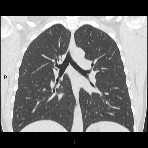 Accidental foreign body aspiration (seamstress needle) (Radiopaedia 77740-89983 Coronal lung window 26).jpg
