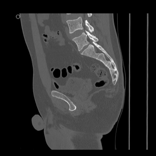 Acetabular and ilial fractures (Radiopaedia 59084-66378 Sagittal bone window 56).jpg