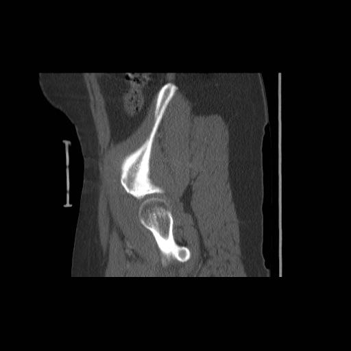 File:Acetabular fracture (Radiopaedia 13193-13212 Sagittal bone window 16).jpg
