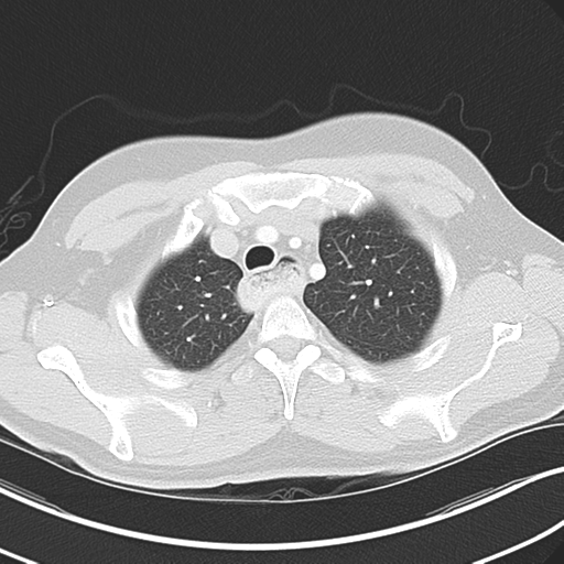 Achalasia of the cardia (Radiopaedia 38497-40595 Axial lung window 12).png