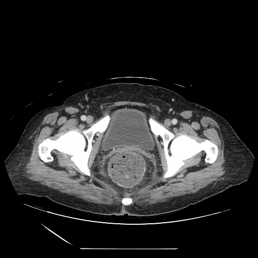 Acinar cell carcinoma of the pancreas (Radiopaedia 75442-86669 Axial C+ portal venous phase 142).jpg