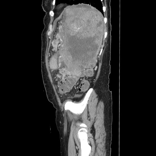 Acinar cell carcinoma of the pancreas (Radiopaedia 75442-86669 Sagittal C+ portal venous phase 154).jpg