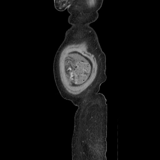 File:Acinar cell carcinoma of the pancreas (Radiopaedia 75442-86669 Sagittal C+ portal venous phase 183).jpg