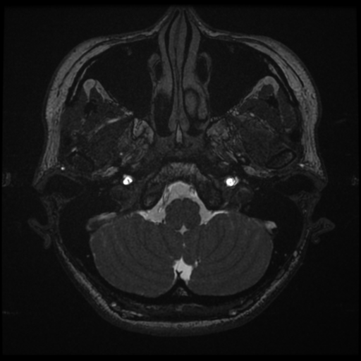 File:Acoustic neuroma (Radiopaedia 34049-35283 Axial 18).png