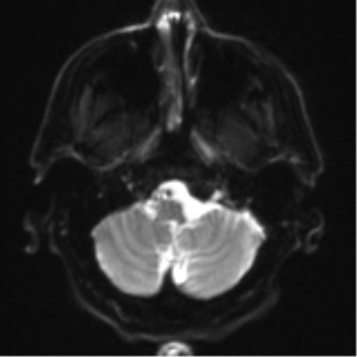 Acoustic schwannoma (Radiopaedia 55729-62281 E 2).png