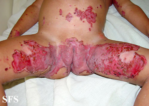 File:Acrodermatitis Enteropathica (Dermatology Atlas 15).jpg