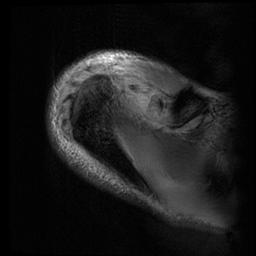 File:Acromioclavicular joint dislocation (Radiopaedia 14218-14076 Axial Gradient Echo 3).jpg