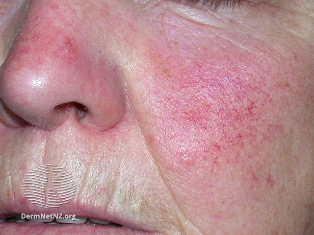 Actinic Keratoses affecting the face (DermNet NZ lesions-ak-face-539).jpg