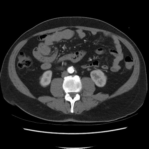Active colonic bleed on CT (Radiopaedia 49765-55025 Axial C+ arterial phase 44).jpg