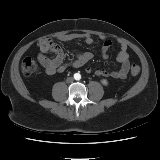 Active colonic bleed on CT (Radiopaedia 49765-55025 Axial C+ arterial phase 47).jpg
