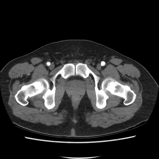 File:Active colonic bleed on CT (Radiopaedia 49765-55025 Axial C+ arterial phase 83).jpg