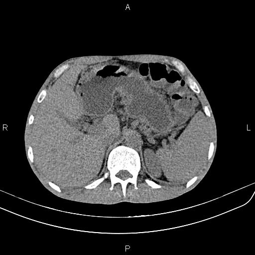 File:Active crohn disease (Radiopaedia 87133-103397 Axial non-contrast 25).jpg