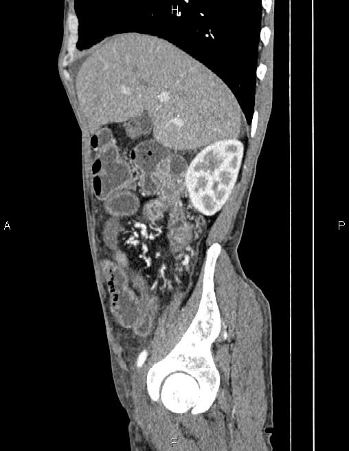 Active crohn disease (Radiopaedia 87133-103397 Sagittal C+ arterial phase 22).jpg