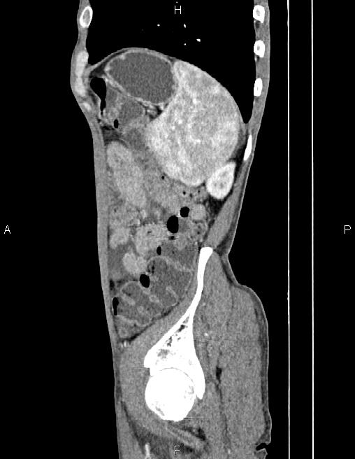 Active crohn disease (Radiopaedia 87133-103397 Sagittal C+ arterial phase 74).jpg