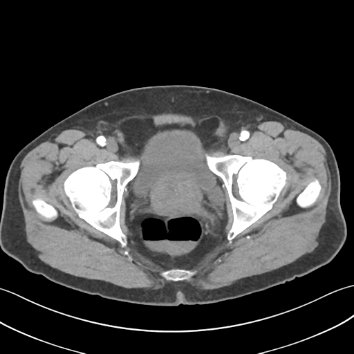 File:Active diverticular hemorrhage (Radiopaedia 39415-41725 Axial C+ arterial phase 67).png