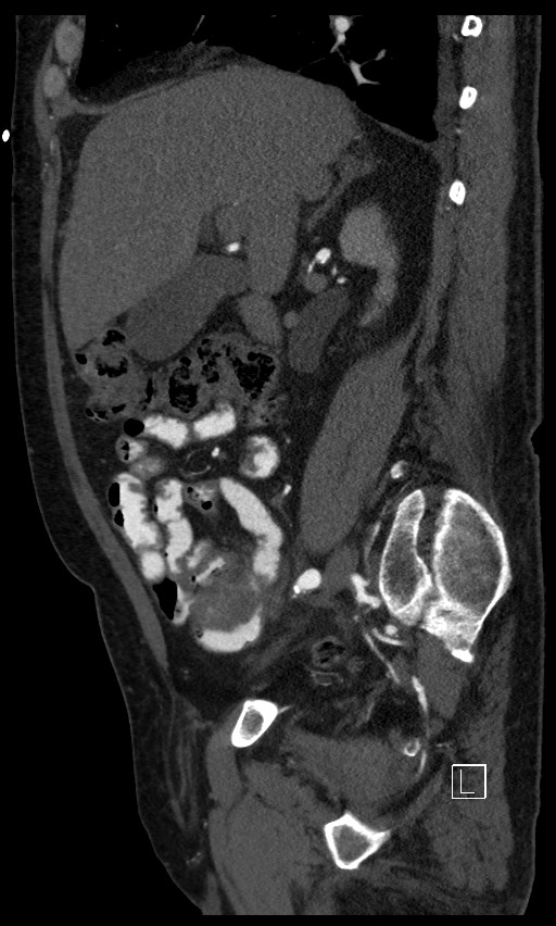 Active lower gastrointestinal bleeding - diverticular (Radiopaedia 61203-69106 Sagittal C+ arterial phase 104).jpg