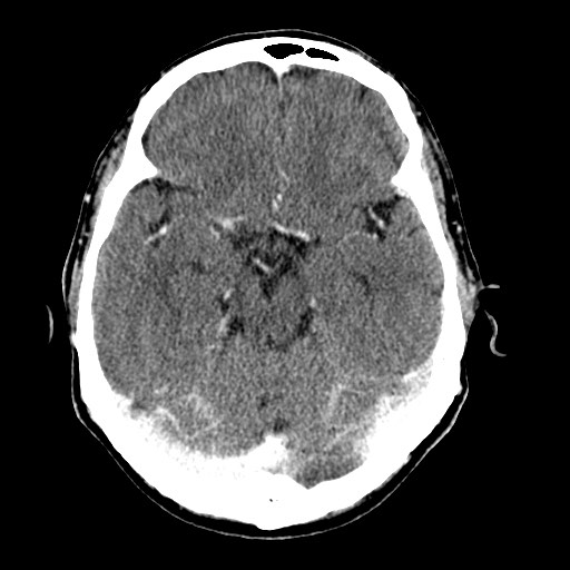 File:Active neurocysticercosis before and after therapy (Radiopaedia 71710-82099 Axial C+ delayed 66).jpg