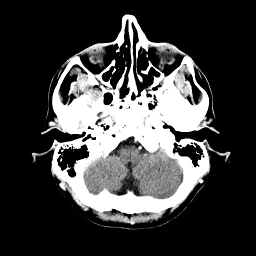 File:Active neurocysticercosis before and after therapy (Radiopaedia 71710-82100 Axial C+ delayed 7).jpg