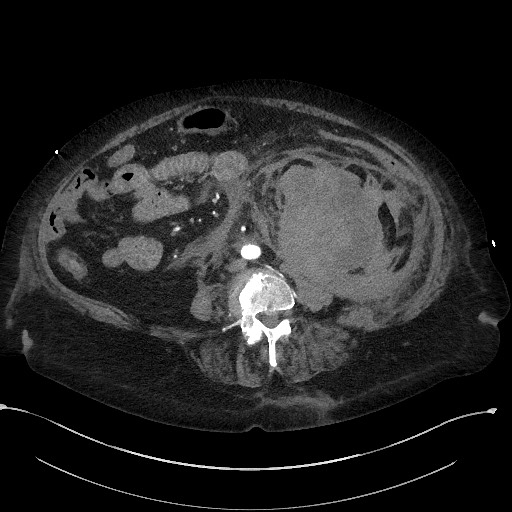 Active renal extravasation with large subcapsular and retroperitoneal hemorrhage (Radiopaedia 60975-68796 Axial C+ arterial phase 109).jpg