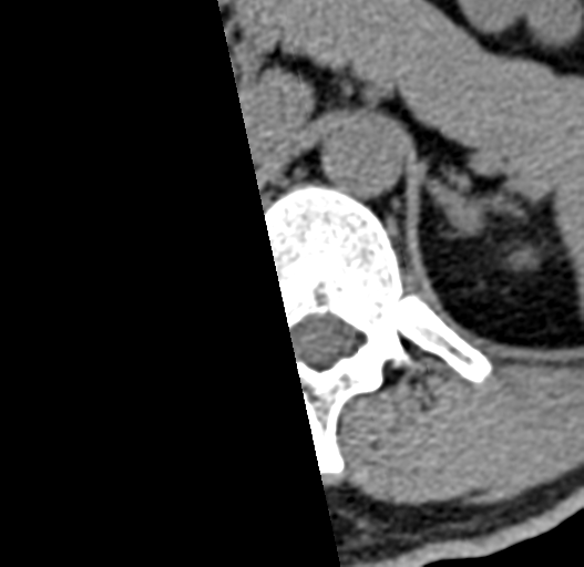 File:Acute L1 burst compression fracture (Radiopaedia 34430-35755 Axial non-contrast 2).png