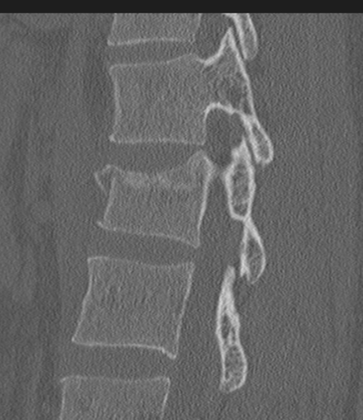 Acute L1 burst compression fracture (Radiopaedia 34430-35755 Sagittal bone window 40).png