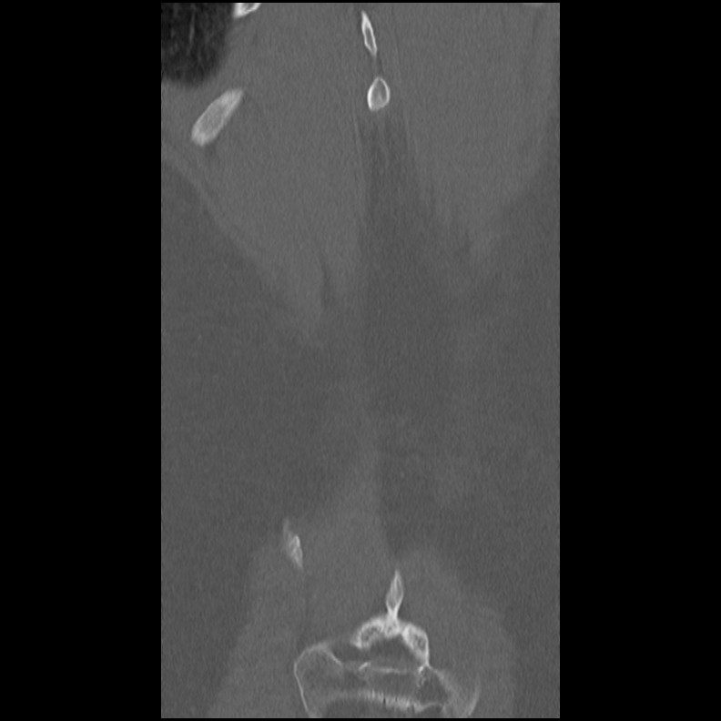 Acute Schmorl's node (Radiopaedia 83276-102365 Coronal bone window 57).jpg