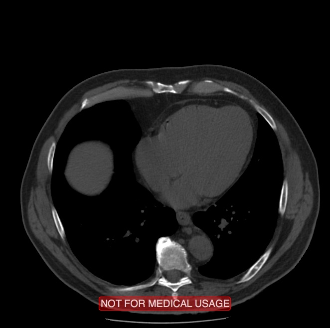 Acute aortic dissection - Stanford type A (Radiopaedia 40661-43285 Axial non-contrast 45).jpg