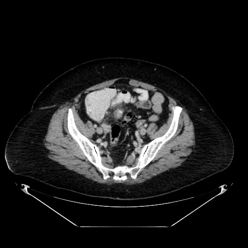 Acute appendicitis, heterotaxy syndrome (Radiopaedia 66884-76202 Axial C+ portal venous phase 103).jpg
