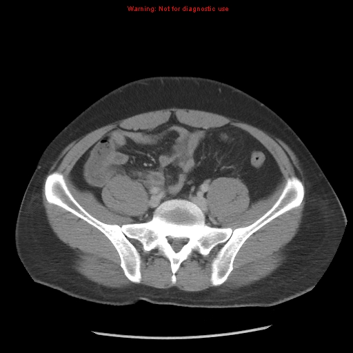 Acute appendicitis (Radiopaedia 10498-10973 Axial C+ portal venous phase 26).jpg