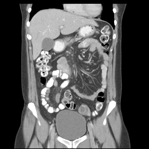File:Acute appendicitis (Radiopaedia 30297-30934 Coronal C+ portal venous phase 17).jpg