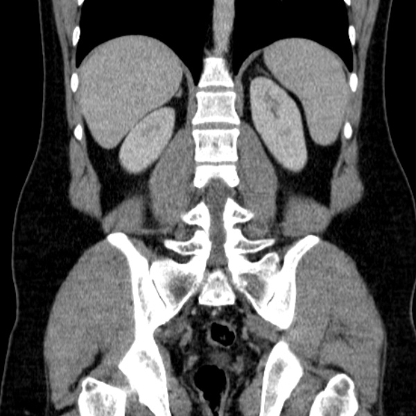 Acute appendicitis (Radiopaedia 38255-40270 Coronal C+ portal venous phase 61).jpg