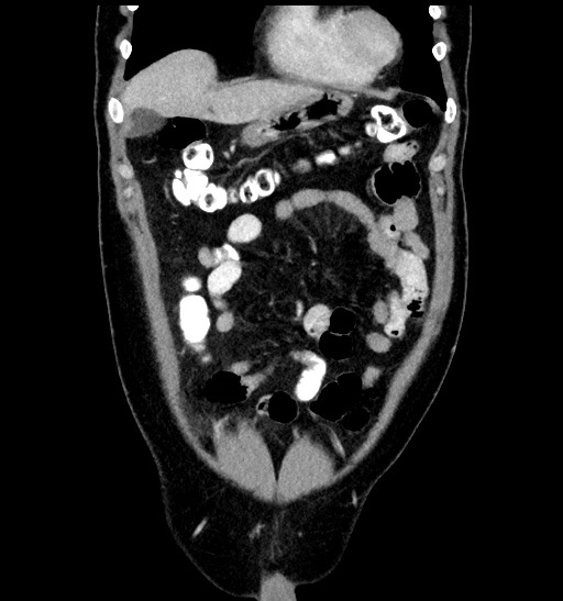 Acute appendicitis (Radiopaedia 77016-88960 Coronal C+ portal venous phase 30).jpg