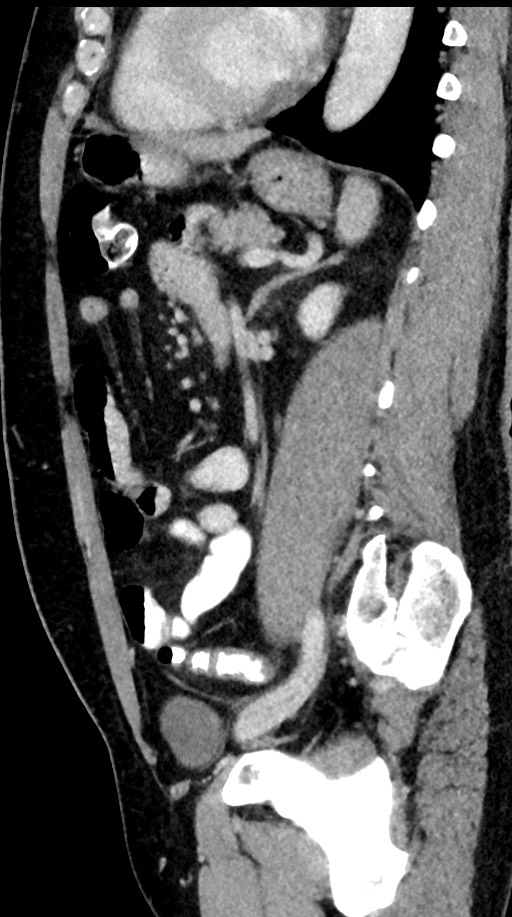 Acute appendicitis (Radiopaedia 77016-88960 Sagittal C+ portal venous phase 44).jpg