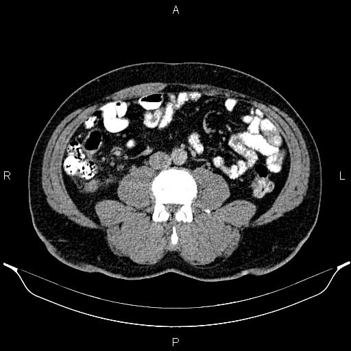 File:Acute appendicitis (Radiopaedia 84780-100240 Axial C+ portal venous phase 61).jpg