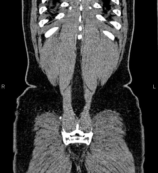Acute appendicitis (Radiopaedia 84780-100240 Coronal C+ portal venous phase 80).jpg
