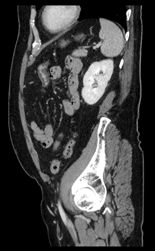 Acute appendicitis - large appendicoliths (Radiopaedia 61805-69820 Sagittal C+ portal venous phase 31).jpg