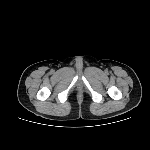 Acute appendicitis and COVID 19 pneumonia (Radiopaedia 76604-88380 Axial non-contrast 127).jpg