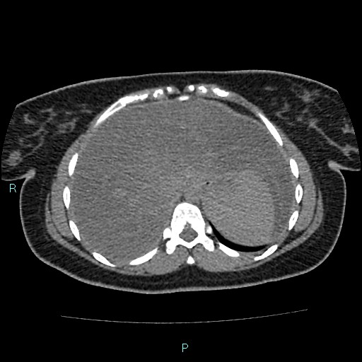 Acute bilateral pyelonephritis (Radiopaedia 37146-38881 Axial non-contrast 16).jpg