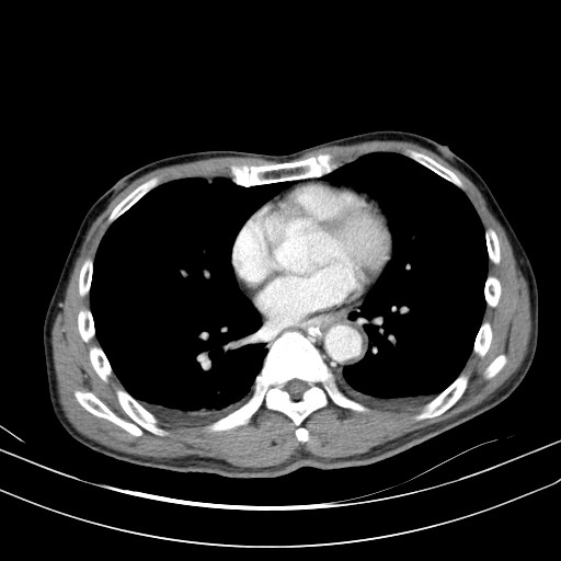 Acute bowel ischemia (Radiopaedia 87695-104114 Axial C+ portal venous phase 2).jpg