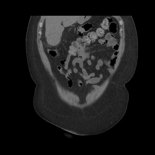 Acute cholecystitis with tensile fundus sign (Radiopaedia 71394-81723 Coronal non-contrast 37).jpg