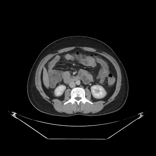 File:Acute complicated calculous cholecystitis (Radiopaedia 55202-61587 Axial C+ delayed 50).jpg