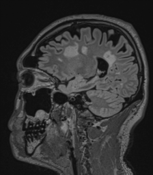 Acute disseminated encephalomyelitis (ADEM)- Anti-NMDA receptor encephalitis (Radiopaedia 54920-61201 Sagittal FLAIR 56).png