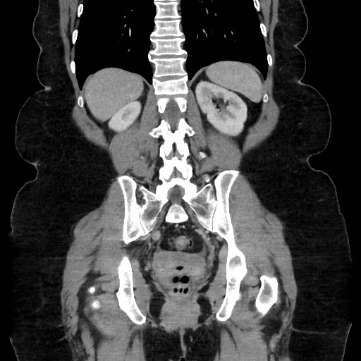 Acute diverticulitis - transverse colon (Radiopaedia 87063-103327 Coronal C+ portal venous phase 113).jpg