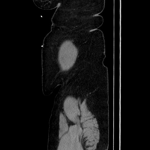 Acute diverticulitis - transverse colon (Radiopaedia 87063-103327 Sagittal C+ portal venous phase 202).jpg