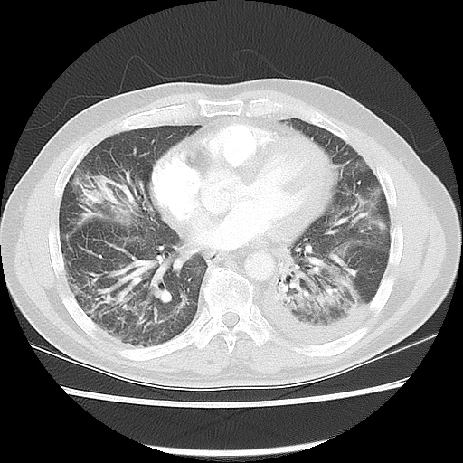 File:Acute epicardial fat necrosis (Radiopaedia 42327-45440 Axial lung window 37).jpg