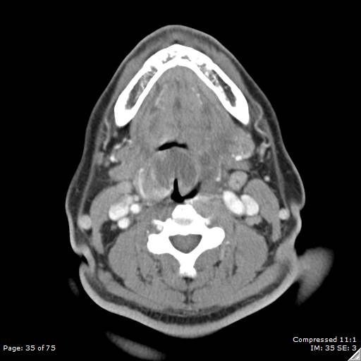 Acute epiglottitis (Radiopaedia 54375-60590 Axial C+ arterial phase 35).jpg