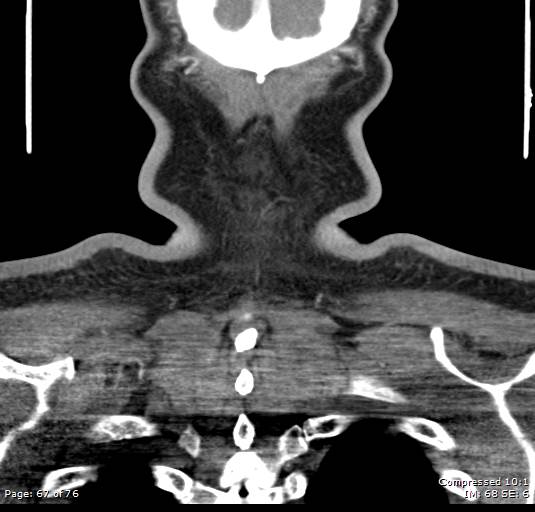 Acute epiglottitis (Radiopaedia 54375-60590 Coronal C+ arterial phase 67).jpg