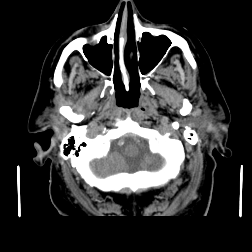 File:Acute hemorrhagic stroke (Radiopaedia 17507-17223 Axial non-contrast 7).jpg
