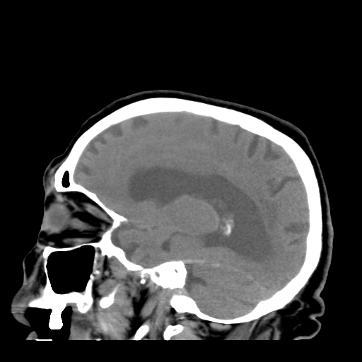 File:Acute hemorrhagic stroke (Radiopaedia 17507-17223 Sagittal non-contrast 31).jpg